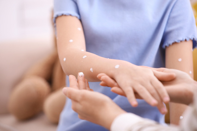 Mother applying cream onto skin of her daughter with chickenpox at home, closeup