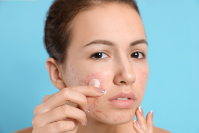 Teen girl applying acne healing patch on light blue background