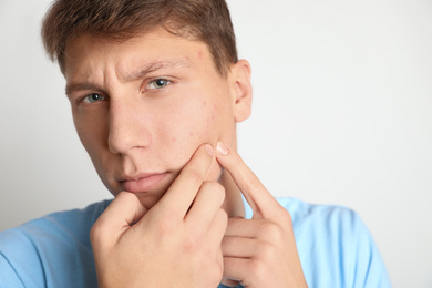 Teen guy with acne problem squeezing pimple on light background