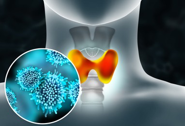 Illustration of human thyroid cancer on dark background