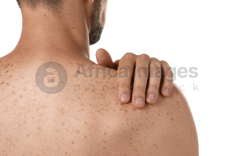 Photo of Closeup of man`s body with birthmarks on white background, back view