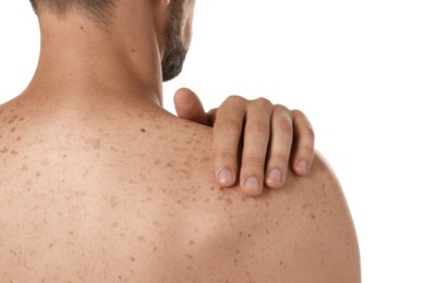 Closeup of man`s body with birthmarks on white background, back view