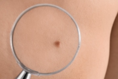 Birthmark of patient under magnifying glass, closeup view. Visiting dermatologist