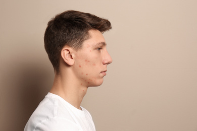 Teen guy with acne problem on beige background. Space for text