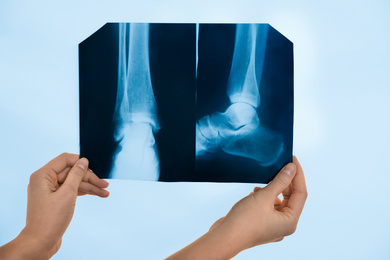 Orthopedist examining X-ray picture on viewing screen, closeup