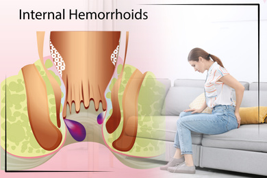 Image of Young woman suffering from hemorrhoid pain on sofa at home. Illustration of unhealthy lower rectum
