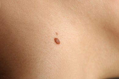 Closeup view of woman's body with birthmarks as background