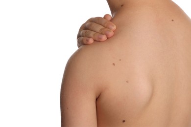 Closeup of boy's body with birthmarks on white background, back view