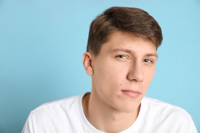 Photo of Teen guy with acne problem on light blue background