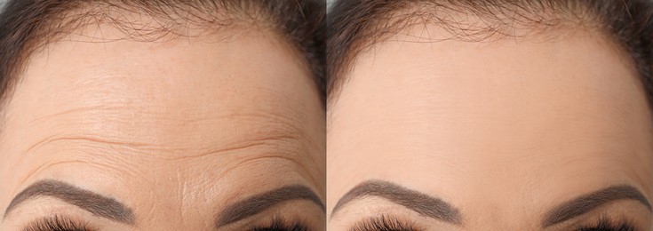 Image of Woman before and after rejuvenating procedures. Collage with photos, closeup