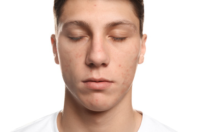 Teen guy with acne problem on white background, closeup