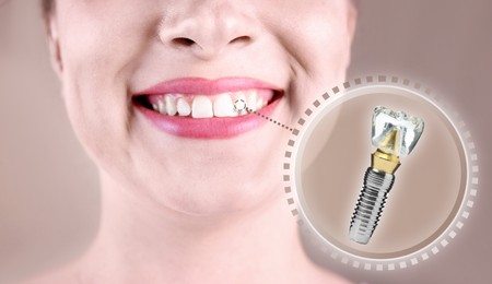 Woman with beautiful smile after dental implant installation procedure on beige background, closeup