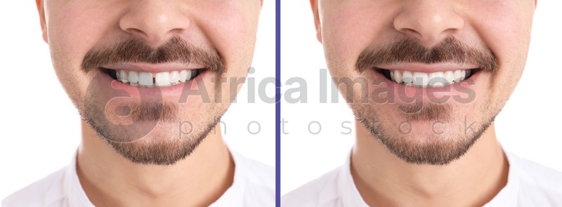 Collage with photos of man with diastema between upper front teeth before and after treatment on white background, closeup. Banner design