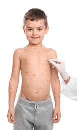Doctor applying cream onto skin of little boy with chickenpox on white background. Varicella zoster virus