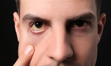 Man checking his health condition on black background, closeup. Yellow eyes as symptom of problems with liver