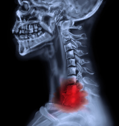 Illustration of  X-ray of patient with cancer. Illustration