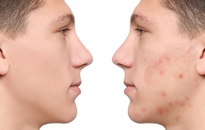 Image of Collage with photos of teen guy with acne problem before and after treatment on white background