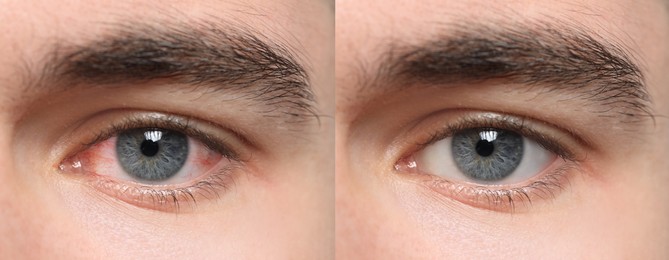 Collage with photos of man with inflamed and healthy eyes before and after treatment, closeup. Banner design