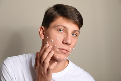 Teen guy with acne problem applying cream on beige background