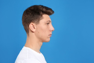 Photo of Teen guy with acne problem on blue background. Space for text