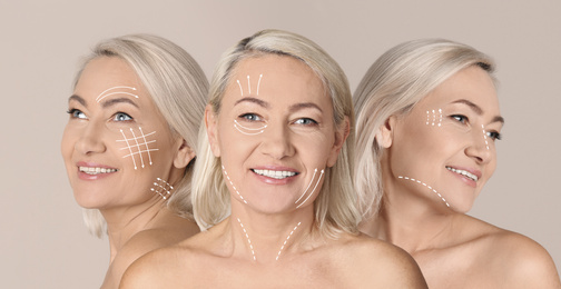 Photos of mature woman with lifting marks on face against beige background, collage. Cosmetic surgery
