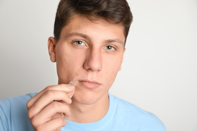 Photo of Teen guy applying acne healing patch on light background