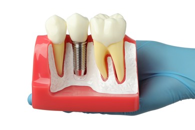 Dentist holding educational model of gum with dental implant between teeth on white background, closeup