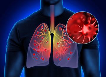 Image of Man with diseased lungs on dark background. Illustration