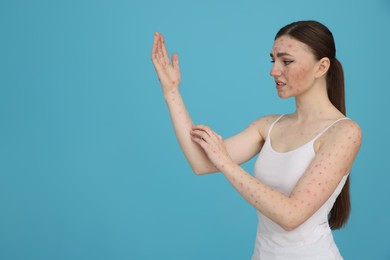 Woman with rash suffering from monkeypox virus on light blue background. Space for text