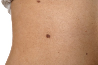 Closeup of woman's body with birthmarks on white background