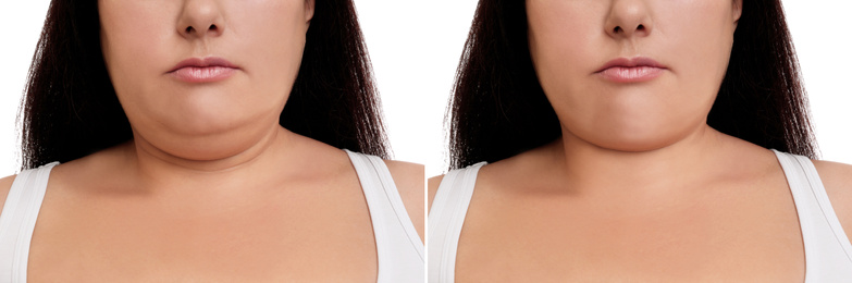 Woman before and after plastic surgery operation on white background, closeup. Double chin problem