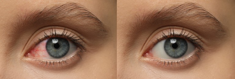 Collage with photos of woman with inflamed and healthy eyes before and after treatment, closeup. Banner design