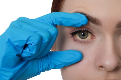 Doctor checking woman with yellow eyes on white background, closeup. Symptom of hepatitis