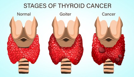Set with illustration of healthy and diseased thyroid on light background. Stages of development cancer