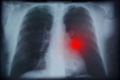 Illustration of X-ray image of patient with lung cancer. Illustration