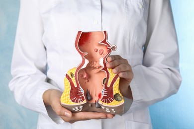 Doctor holding model of unhealthy lower rectum on light blue background, closeup. Hemorrhoid problem