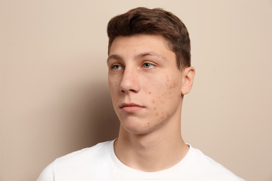 Photo of Teen guy with acne problem on beige background
