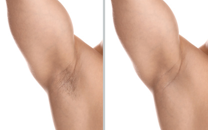 Collage of man showing armpit before and after epilation on white background, closeup 