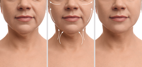 Mature woman before and after plastic surgery operation on white background, closeup. Double chin problem 