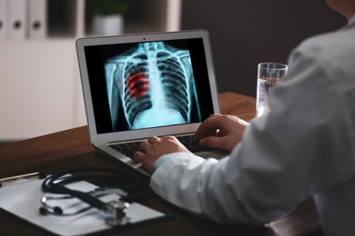 Image of Doctor examining x-ray of patient with lung cancer on laptop in clinic, closeup