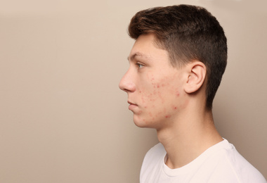 Photo of Teen guy with acne problem on beige background. Space for text