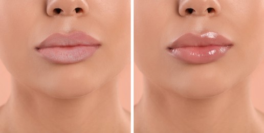 Collage with photos of woman with dry and moisturized lips, closeup. Banner design