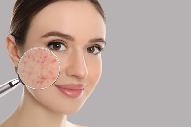 Young woman with acne problem on grey background, space for text. Skin under magnifying glass