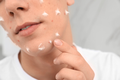 Photo of Teen guy with acne problem applying cream indoors, closeup