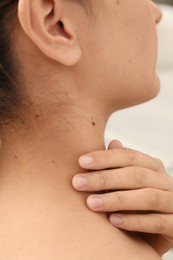 Closeup view of woman`s body with birthmarks