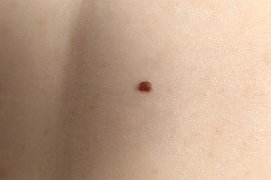 Closeup view of woman's body with birthmarks as background