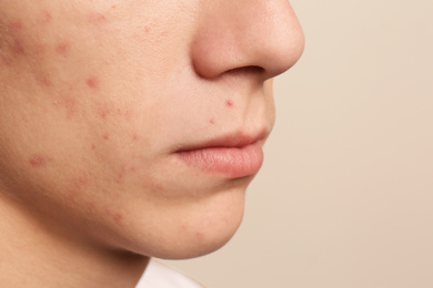 Photo of Teen guy with acne problem on beige background, closeup