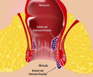 Hemorrhoid. Illustration of unhealthy lower rectum with inflamed vascular structures