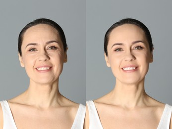 Image of Beautiful mature woman before and after cosmetic procedure on grey background, collage. Plastic surgery