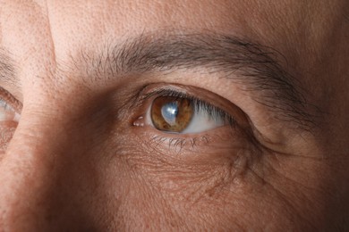 Closeup view of mature man suffering from cataract